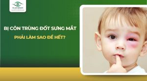 bị côn trùng đốt sưng mắt