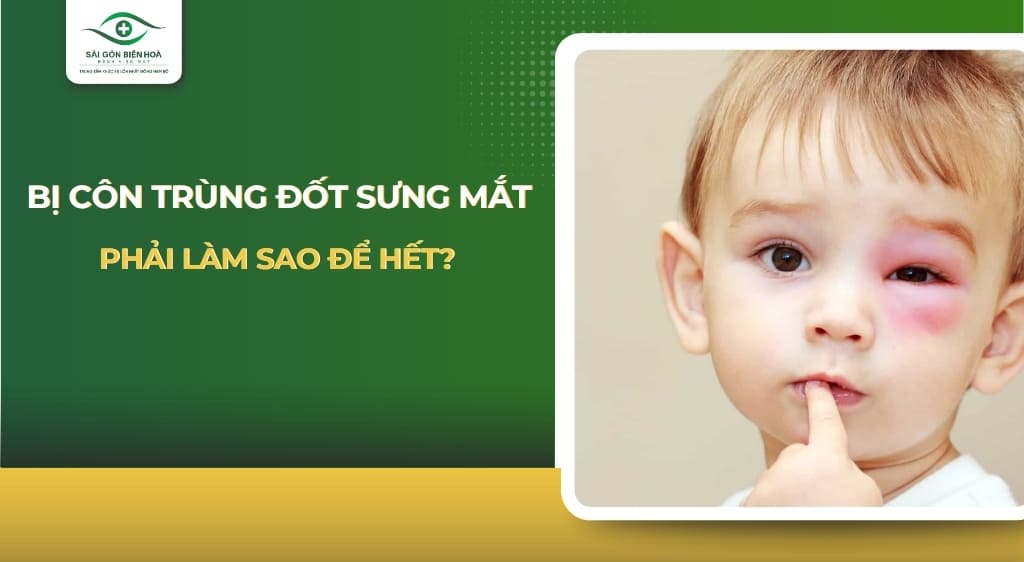 bị côn trùng đốt sưng mắt