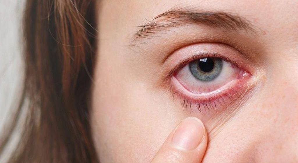 Bị dầu nóng bắn vào mắt có thể gây kích ứng, đau rát