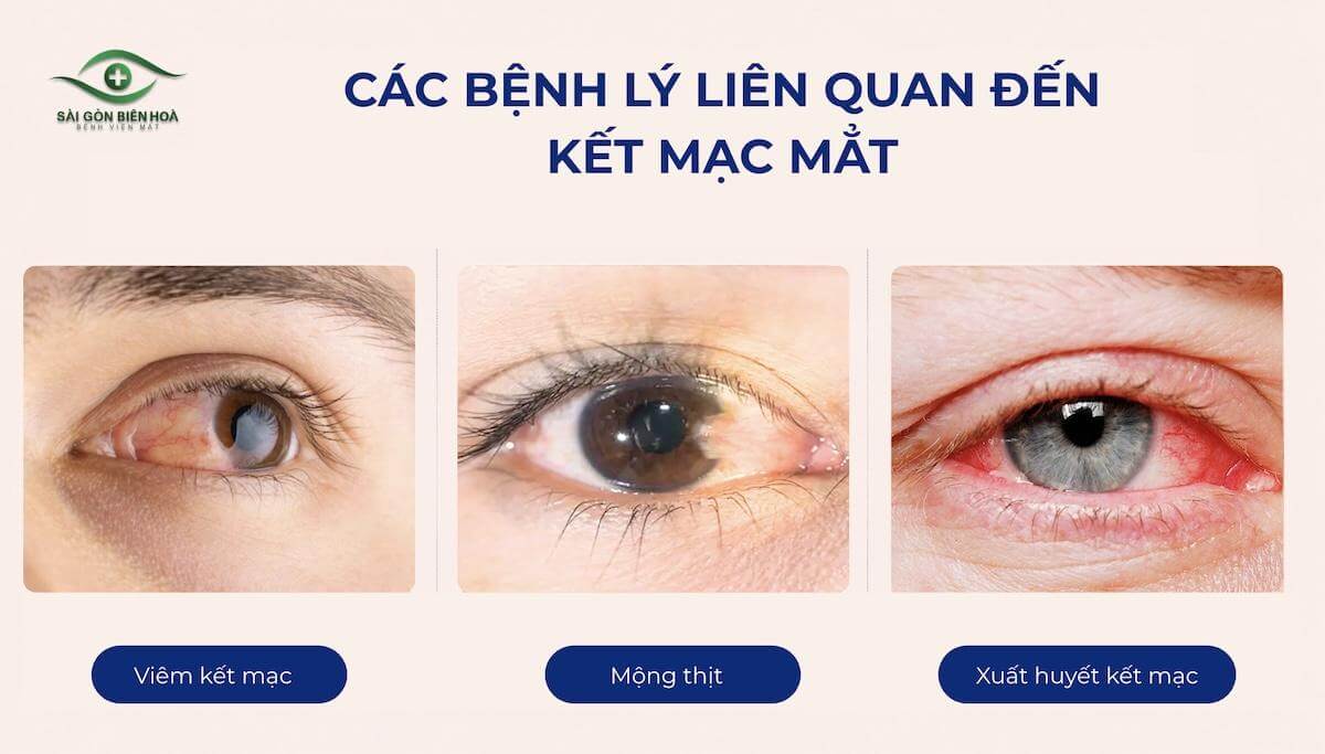 Các bệnh lý liên quan đến kết mạc mắt