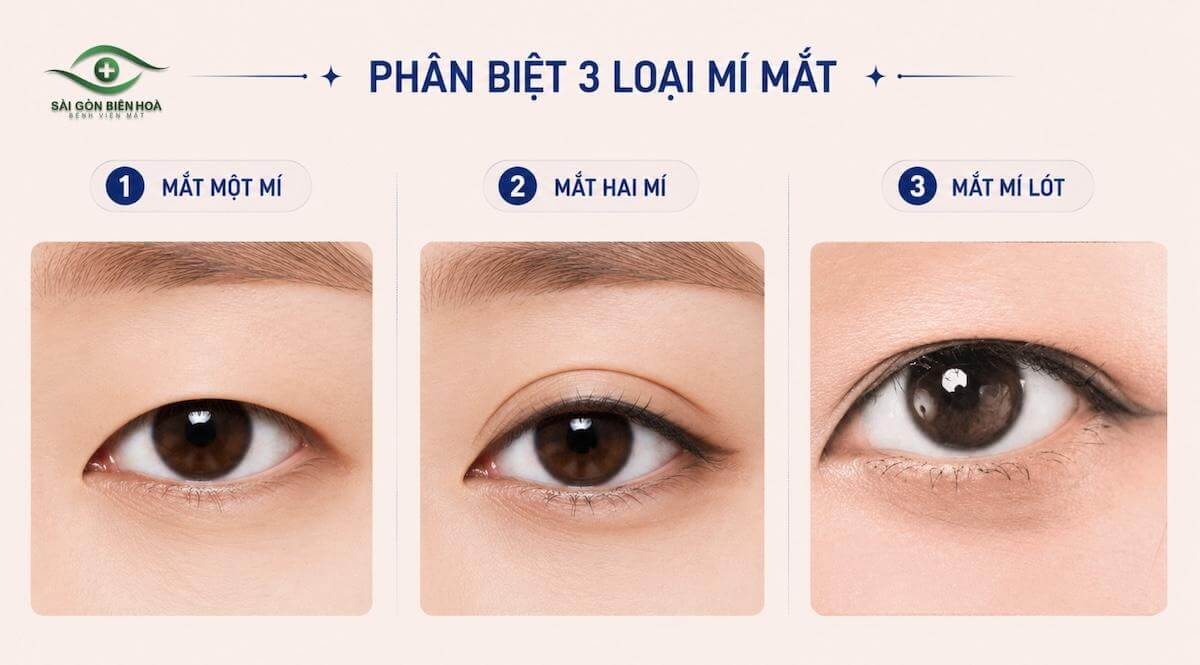 Các loại mí mắt