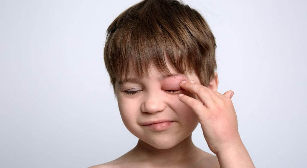 Cần sơ cứu ban đầu và đưa trẻ đến cơ sở y tế nếu xuất hiện tình trạng sưng nặng