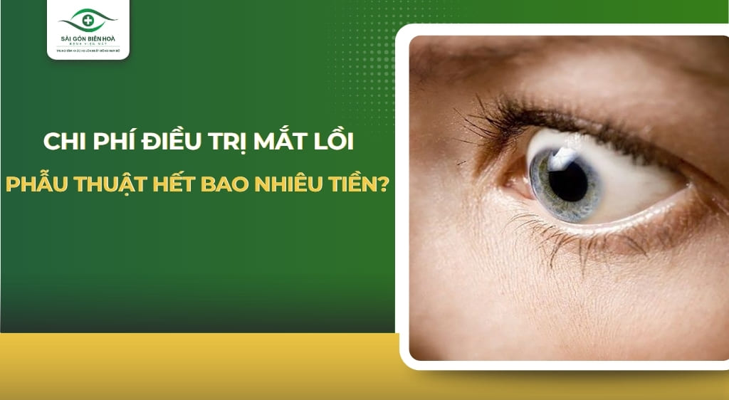 chi phí điều trị mắt lồi