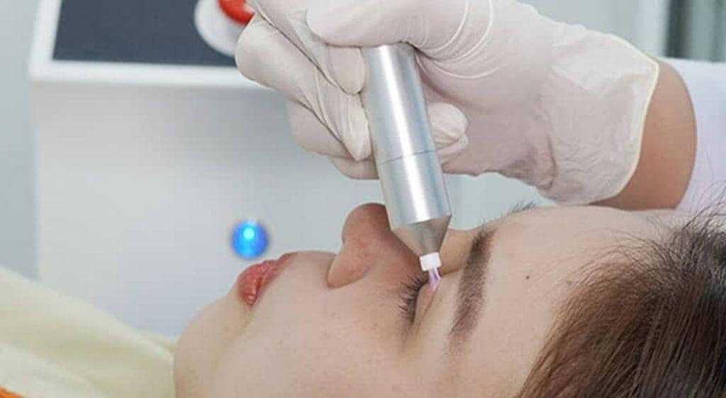 Công nghệ Laser CO2 siêu xung chính là tiêu chuẩn vàng trong điều trị u vàng hiện nay