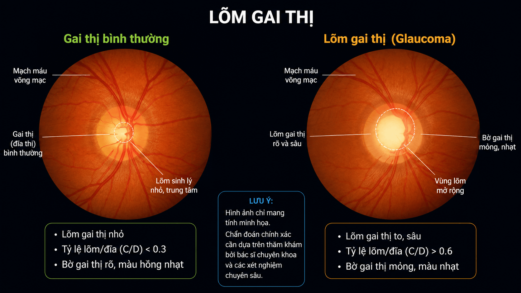 Gai thị bình thường so sánh với lõm gai thị