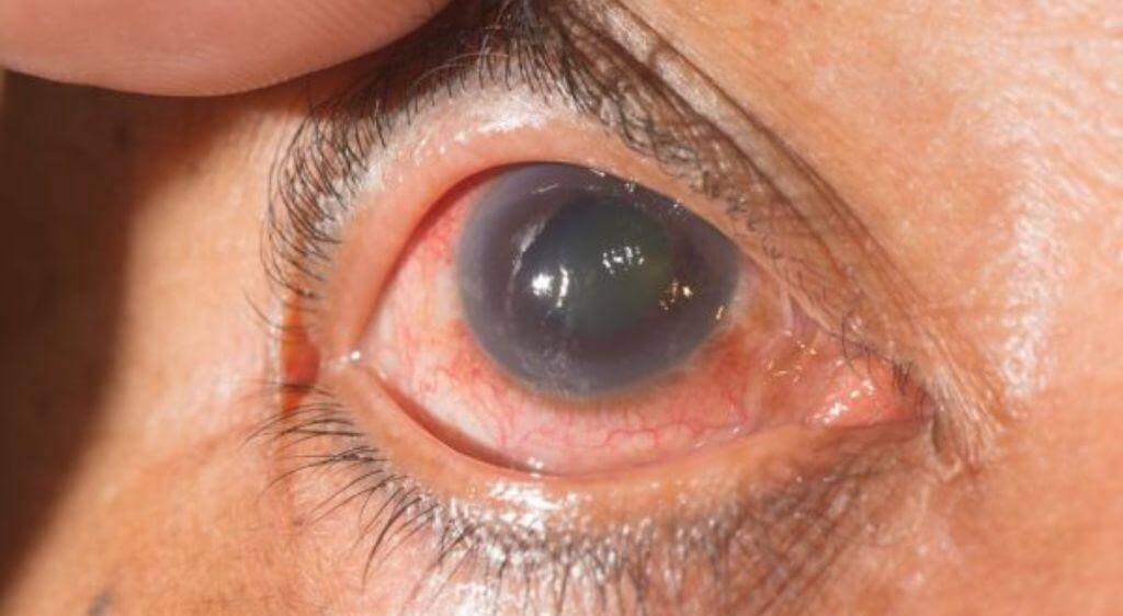 Glaucoma là một nhóm bệnh lý gây tổn thương dây thần kinh thị giác liên quan đến áp lực trong mắt tăng cao