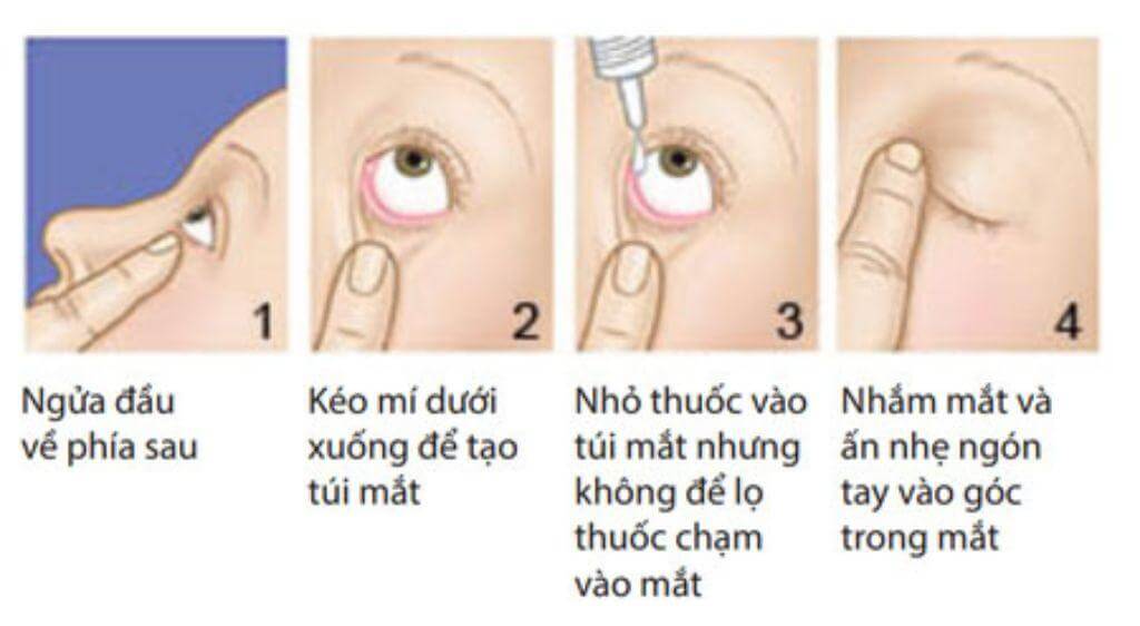 Hướng dẫn sử dụng thuốc nhỏ mắt chống mỏi mắt đúng cách