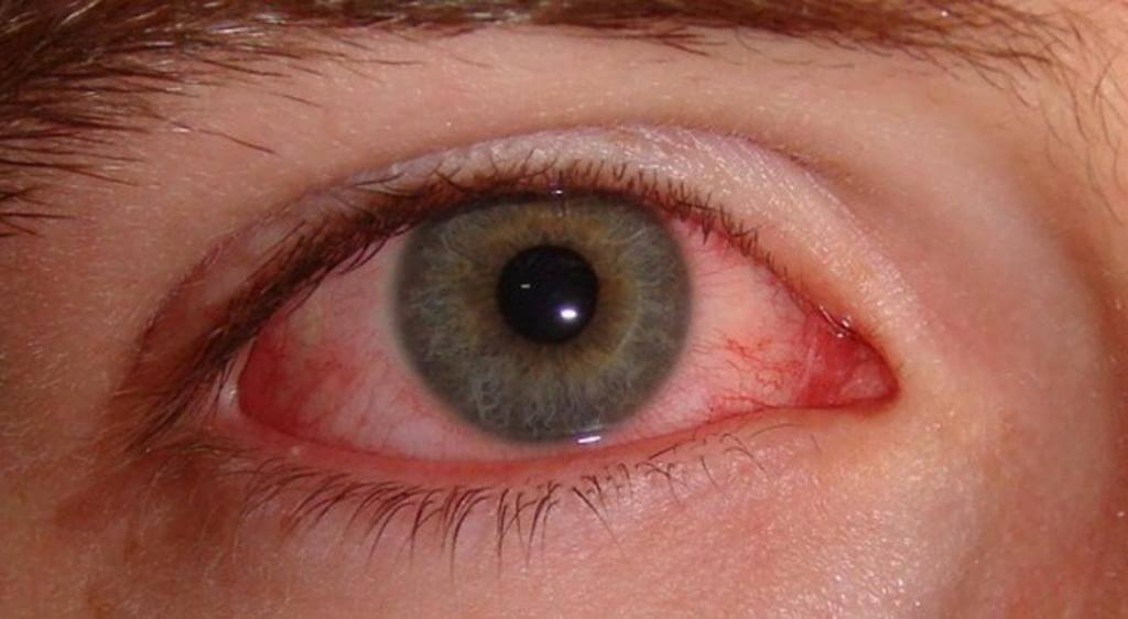 Khô mắt khiến bề mặt mắt bị kích ứng, gây đỏ mắt, đổ ghèn