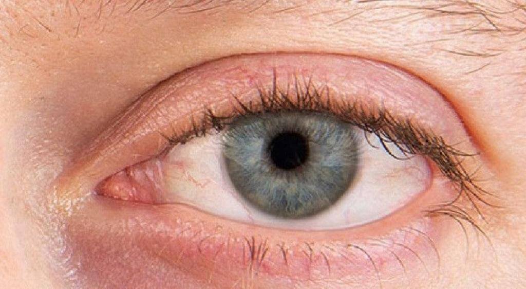 Khô mắt khiến mắt tiết nhiều ghèn trắng đục, kèm cảm giác cộm rát