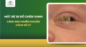 Mắt bé bị đổ ghèn xanh