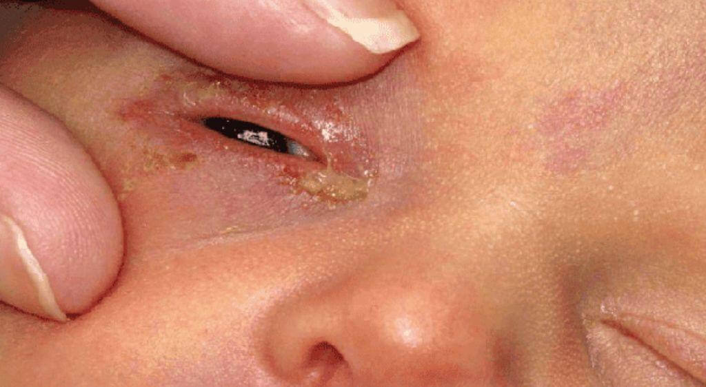 Mắt bé bị đổ ghèn xanh có thể là dấu hiệu nhiễm khuẩn hoặc tắc tuyến lệ