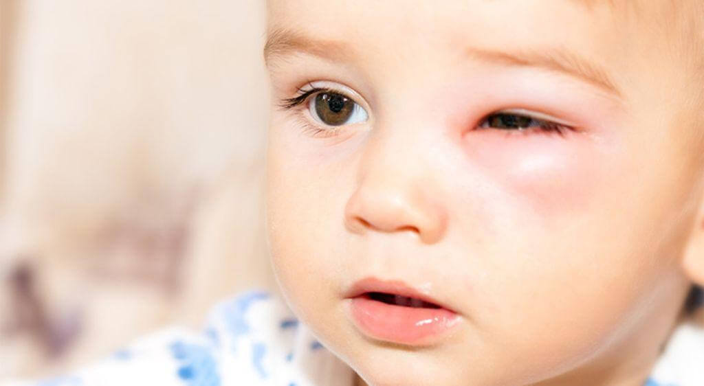 Mắt bé đổ ghèn kèm sưng đau cần đưa bé đi khám ngay