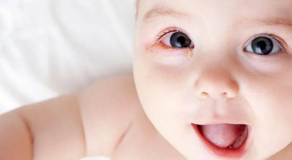 Mắt bé đổ ghèn xanh có thể do nhiễm bẩn hoặc vệ sinh không đúng cách