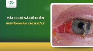 mắt bị đỏ và đổ ghèn