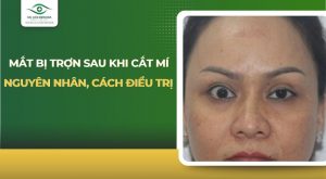 mắt bị trợn sau khi cắt mí
