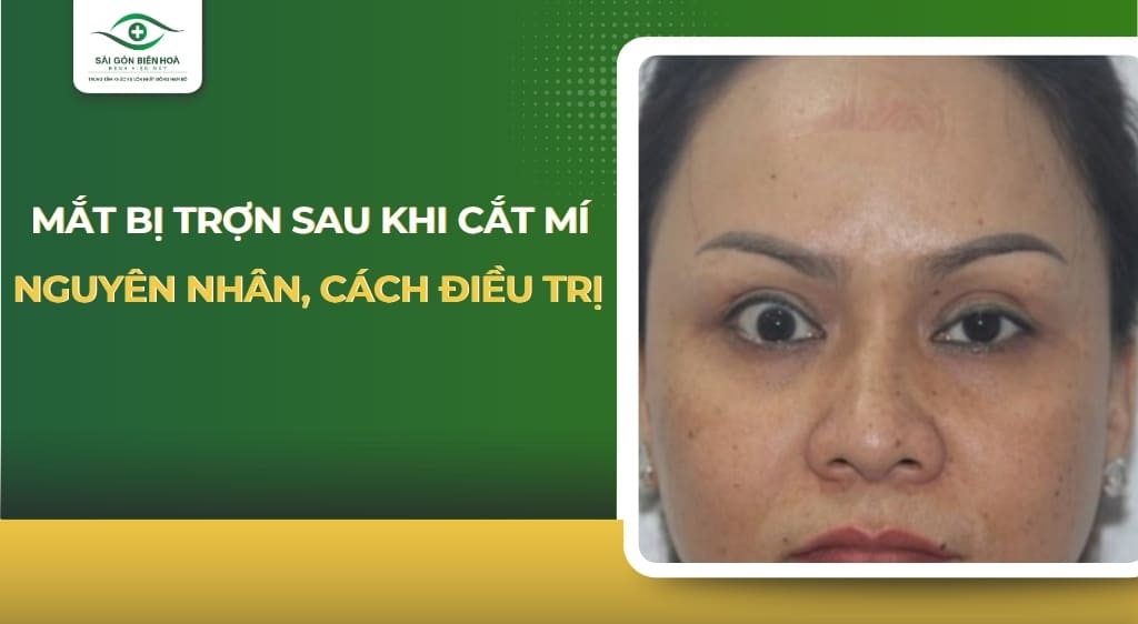 mắt bị trợn sau khi cắt mí