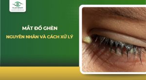 mắt đổ ghèn