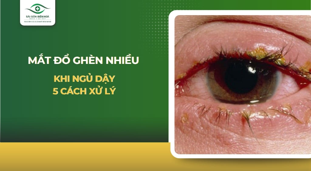 Mắt đổ ghèn nhiều khi ngủ dậy