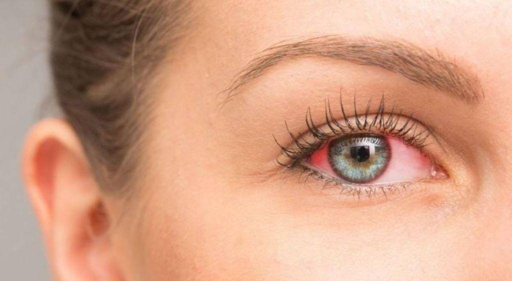Mắt đỏ rực, đau nhức kèm chảy nước mắt sống cần đi khám ngay