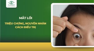 mắt lồi