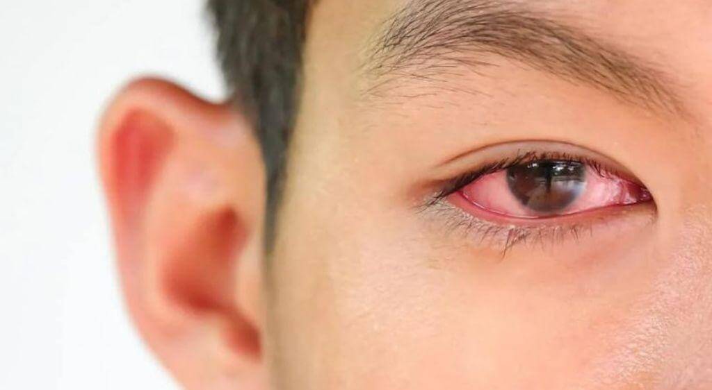 Mắt nhòe mờ sau đau mắt đỏ có thể dẫn đến biến chứng viêm loét giác mạc