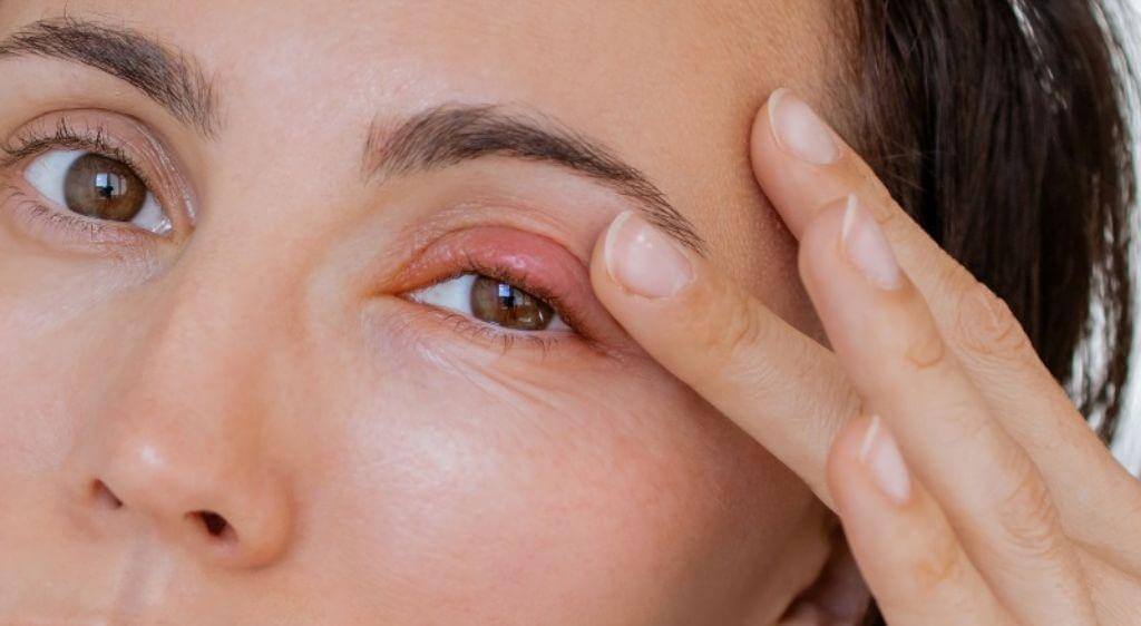 Mắt sưng tấy làm biến dạng nếp mí