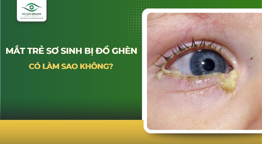 Mắt trẻ sơ sinh bị đổ ghèn