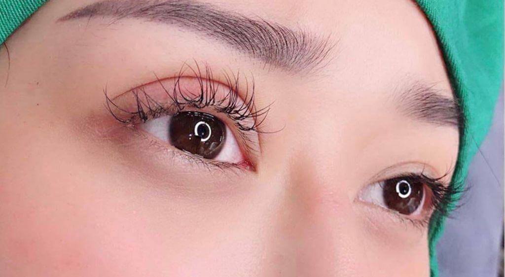Mí mắt sưng nề sau khi phẫu thuật cắt mí