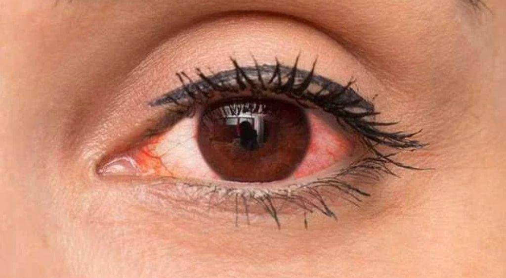 Nhiễm trùng mắt là bệnh lý nhãn khoa nguy hiểm do vi khuẩn, virus, nấm hoặc ký sinh trùng gây ra