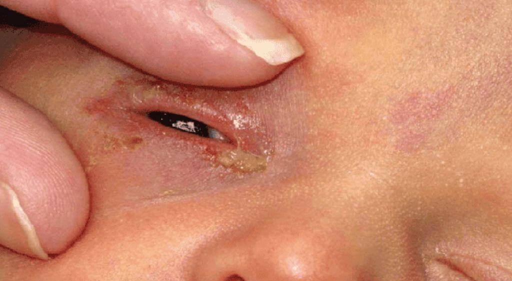 Nhiễm trùng mắt ở trẻ sơ sinh là một cấp cứu nhãn khoa vô cùng nguy hiểm
