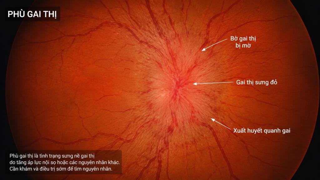 Phù gai thị có thể khiến người bệnh nhìn mờ, đau đầu và buồn nôn