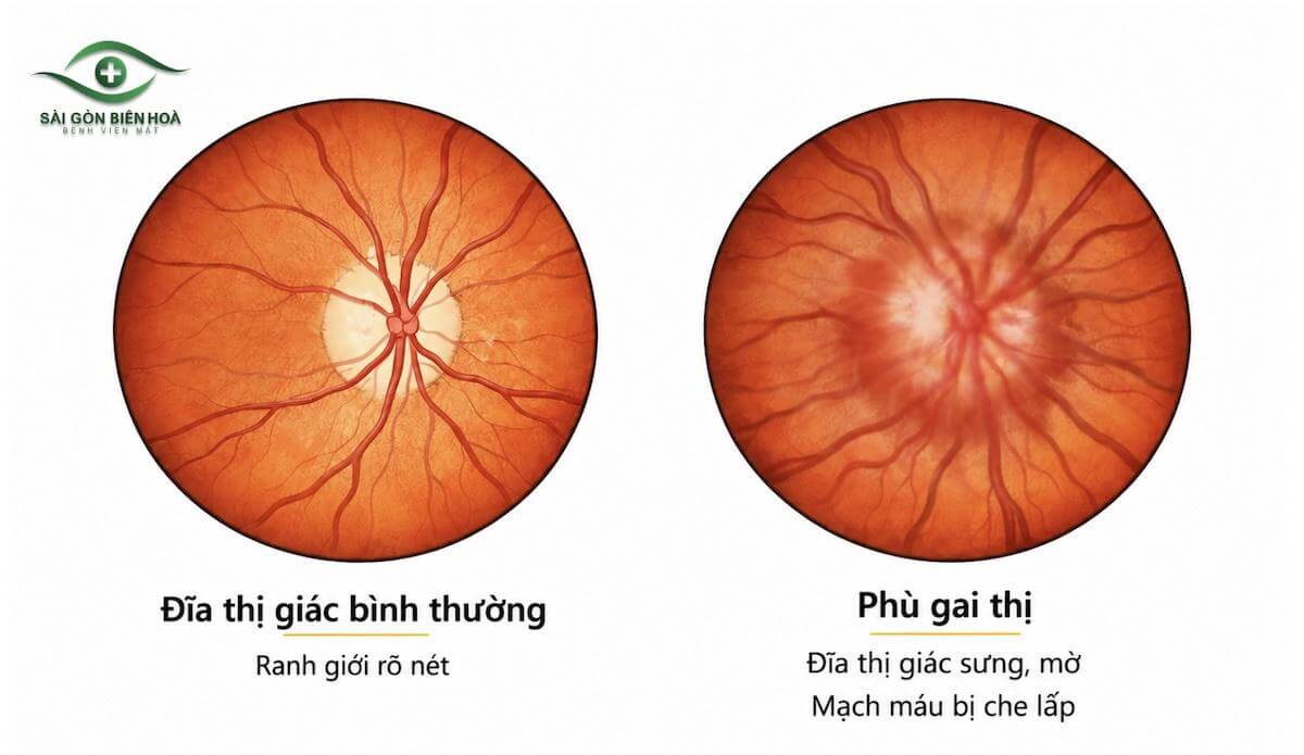Phù gai thị kéo dài có thể gây tổn thương dây thần kinh thị giác không hồi phục