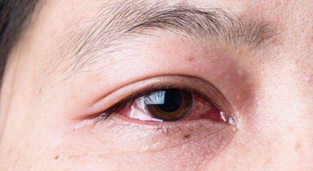 Phù gai thị là tình trạng sưng nề đĩa thị trong mắt