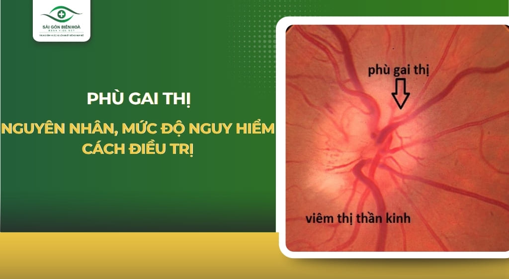 phù gai thị