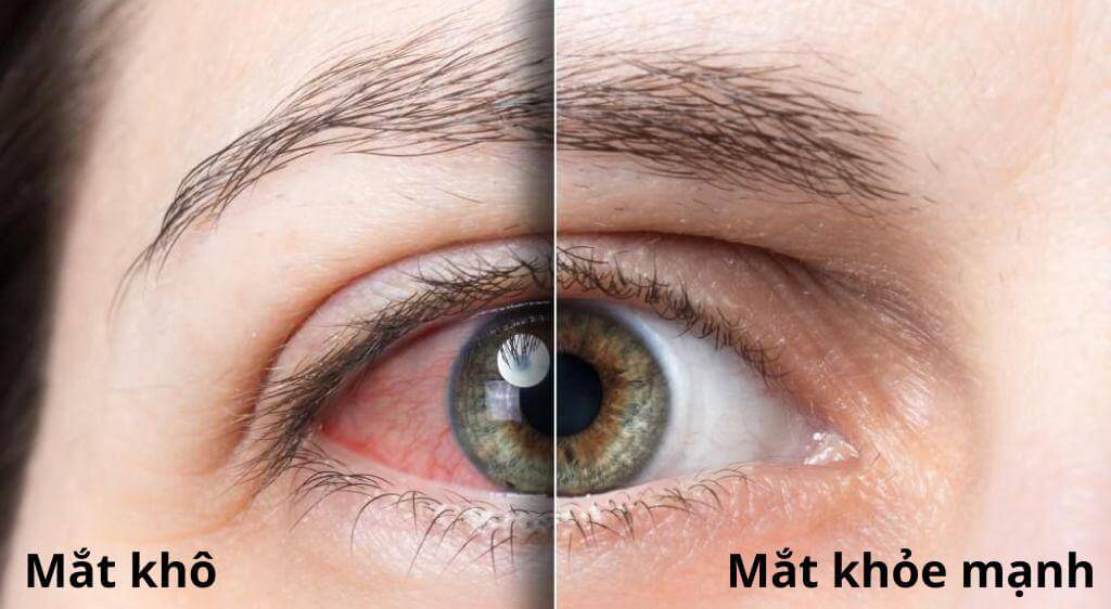 So sánh mắt khô do thiếu vitamin A và mắt khỏe mạnh