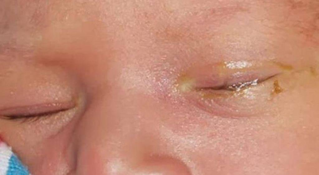 Tắc lệ đạo lâu ngày nếu không được xử lý đúng sẽ khiến vi khuẩn phát triển và gây viêm và đổ ghèn