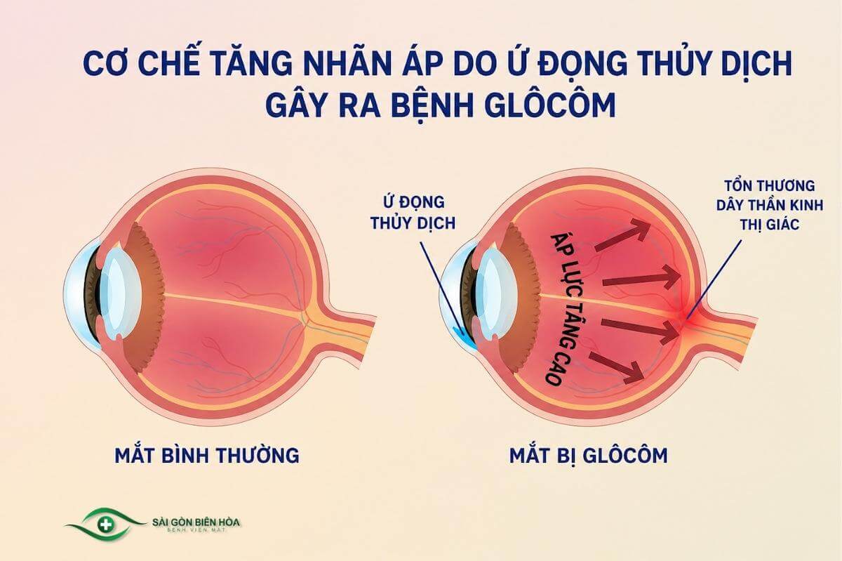 Thuỷ dịch ứ đọng làm tăng nhãn áp - nguyên nhân gây bệnh lý Glaucoma