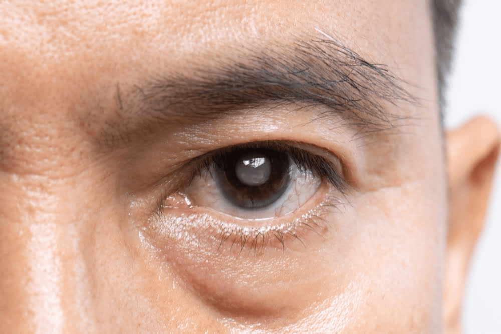 Thủy tinh thể mắt bị mờ đục