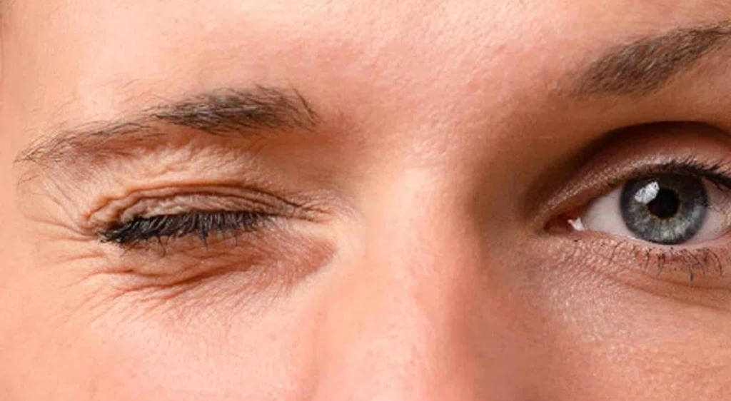 Tình trạng mí mắt co giật ở mức độ nhẹ thường chỉ kéo dài vài giây đến vài phút