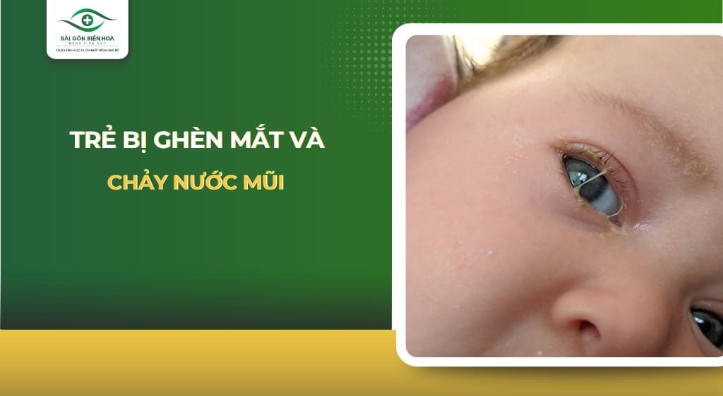 Trẻ bị đổ ghèn mắt và chảy nước mũi