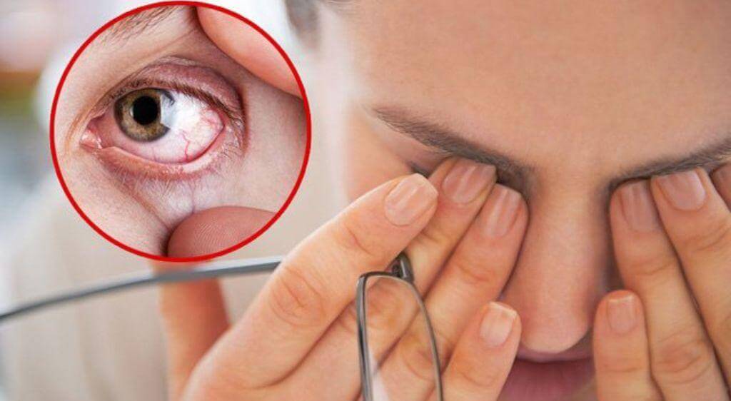Triệu chứng mắt đỏ nhiều, đau đầu cần đi thăm khám ngay