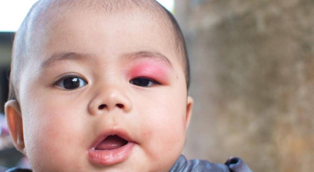 Tùy vào loại côn trùng đốt hoặc cắn, trẻ có thể gặp các triệu chứng khác nhau