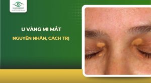 U vàng mi mắt