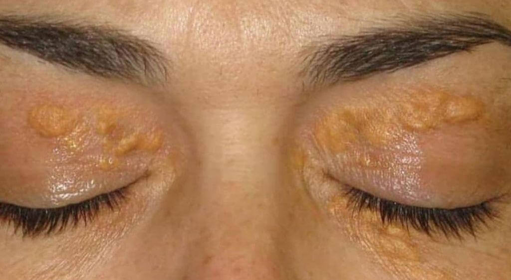 U vàng mi mắt là tình trạng xuất hiện các mảng hoặc nốt sần màu vàng nhạt khu trú quanh vùng mắt