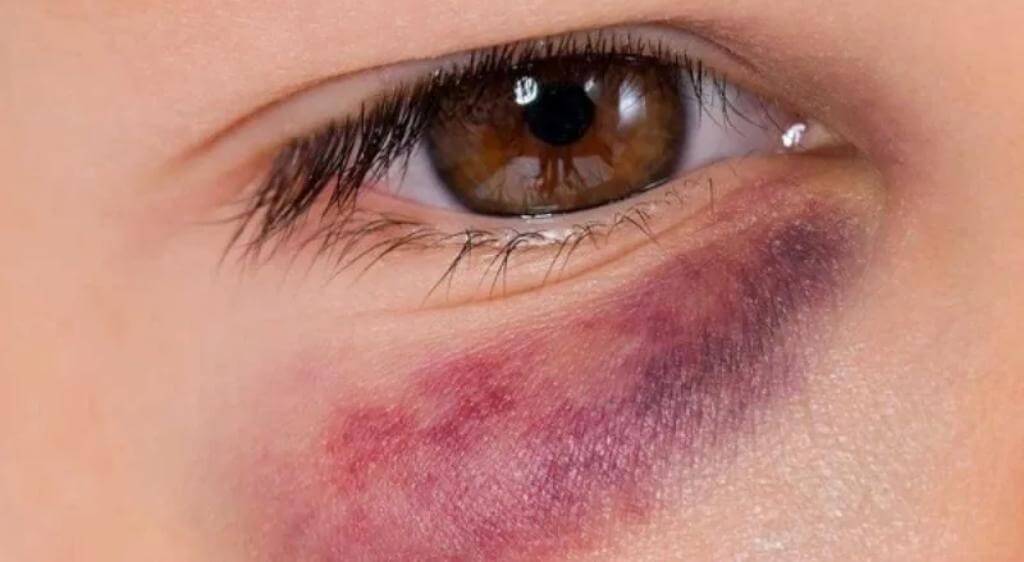 Vết bầm tím lâu tan có thể do lão hóa, tác dụng phụ thuốc hoặc rối loạn đông máu