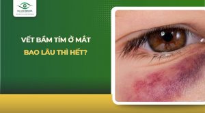 Vết bầm tím ở mắt bao lâu thì hết