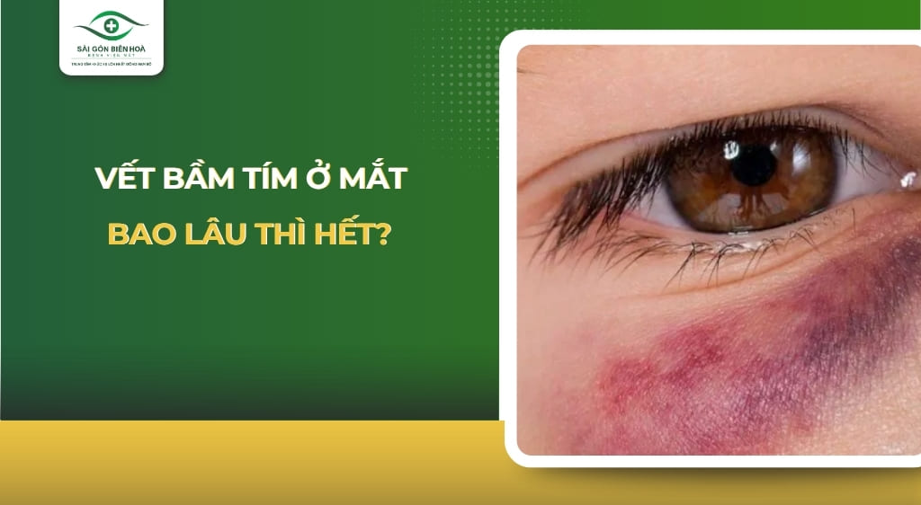 Vết bầm tím ở mắt bao lâu thì hết