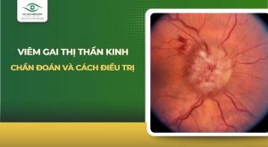 viêm gai thị