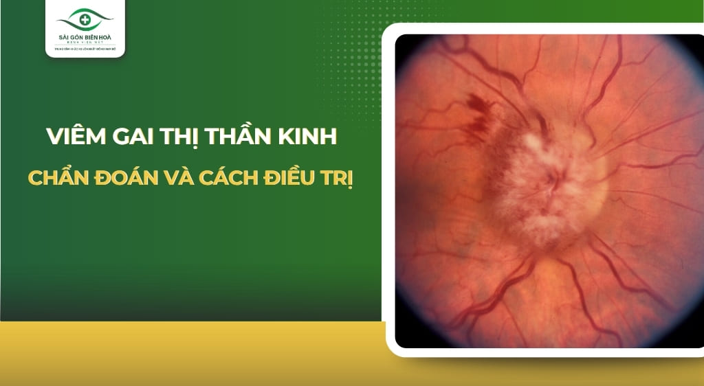 viêm gai thị