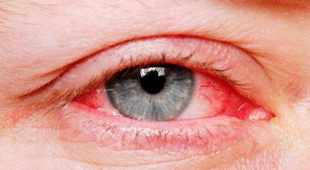 Viêm kết mạc do dị ứng khiến mắt bị đổ ghèn và đỏ, kèm ngứa và chảy nước mắt